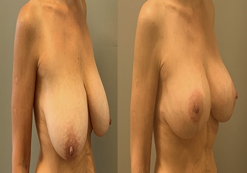 Breast lift without an implant