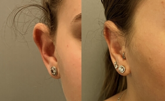 הצמדת אוזניים לפני ואחרי