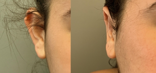 הצמדת אוזניים לפני ואחרי