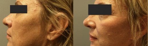 1-שמאל-מתיחת פנים ניתוח אוזניים