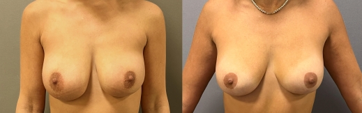 14-פרונט-הקטנה