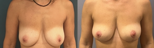 16-פרונט-הקטנה