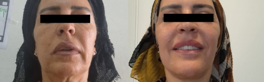 22-פרונט-מתיחת פנים 22-פרונט-מתיחת פנים