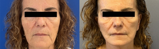 23-פרונט-מתיחת פנים