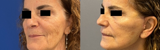 23-שמאל אלכסון-מתיחת פנים