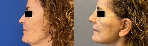 23-שמאל-מתיחת פנים