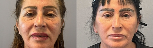 24-פרונט-מתיחת פנים