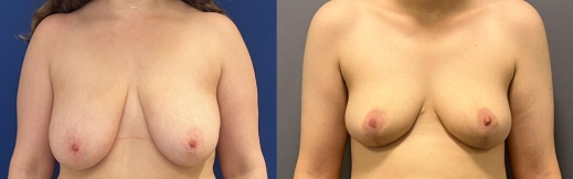 25-פרונט-הקטנה