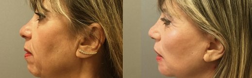4-ימין-מתיחת פנים לפני ואחרי ניתוח 