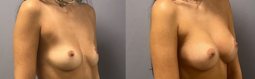 40-ימין-הגדלת חזה 40-ימין-הגדלת חזה