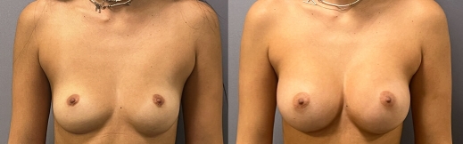 40-פרונט-הגדלת חזה 40-פרונט-הגדלת חזה