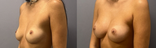 40-שמאל-הגדלת חזה 40-שמאל-הגדלת חזה