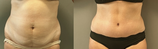 42-פרונט-מתיחת בטן