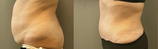 42-שמאל-מתיחת בטן