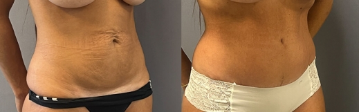 44- ימין-מתיחת בטן 44- ימין-מתיחת בטן