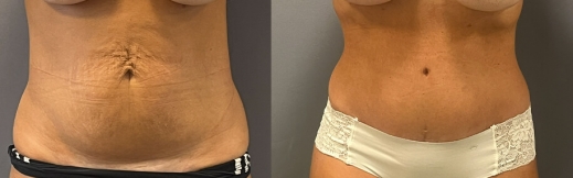 44- פרונט-מתיחת בטן 44- פרונט-מתיחת בטן