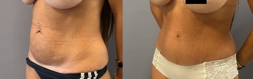 44- שמאל-מתיחת בטן 44- שמאל-מתיחת בטן