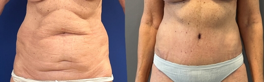 45- פרונט-מתיחת בטן 45- פרונט-מתיחת בטן