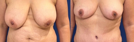 46-  פרונט-מתיחת בטן