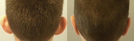 6-ניתוח הצמדת אוזניים - אחורי