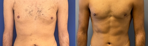 גניקומסטיה-37- פרונט