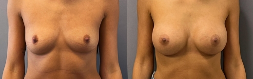 הגדלת חזה - 34 - פרונט הגדלת חזה - 34 - פרונט