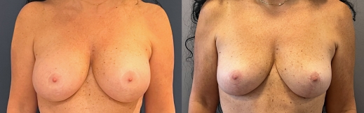 הוצאת שתלים - 21 - פרונט הוצאת שתלים - 21 - פרונט