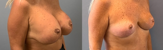 הוצאת שתלים - 34 - ימין הוצאת שתלים - 34 - ימין