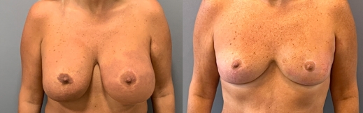 הוצאת שתלים - 34 - פרונט הוצאת שתלים - 34 - פרונט