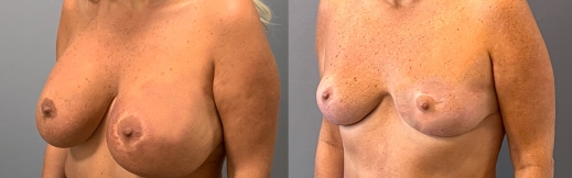 הוצאת שתלים - 34 - שמאל הוצאת שתלים - 34 - שמאל