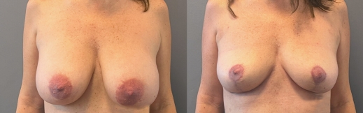 הוצאת שתלים - 36 - פרונט הוצאת שתלים - 36 - פרונט