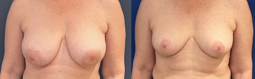 הוצאת שתלים - 37 - פרונט הוצאת שתלים - 37 - פרונט