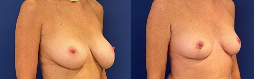 הוצאת שתלים - 38 - ימין הוצאת שתלים - 38 - ימין