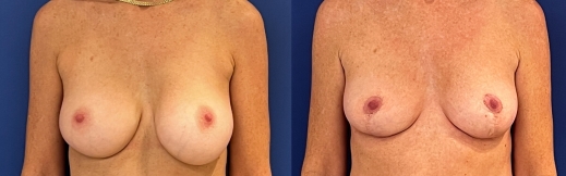 הוצאת שתלים - 38 - פרונט הוצאת שתלים - 38 - פרונט