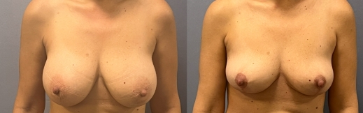 הוצאת שתלים - 39 - פרונט הוצאת שתלים - 39 - פרונט