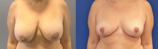 הוצאת שתלים - 40 - פרונט הוצאת שתלים - 40 - פרונט