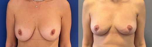 הוצאת שתלים - 41 - פרונט הוצאת שתלים - 41 - פרונט