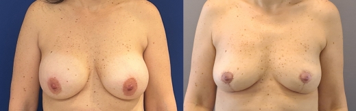 הוצאת שתלים - 42 - פרונט הוצאת שתלים - 42 - פרונט