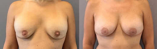 החלפת שתלים - 12 - פרונט החלפת שתלים - 12 - פרונט