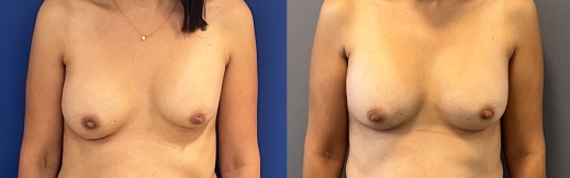 החלפת שתלים - 13 - פרונט החלפת שתלים - 13 - פרונט