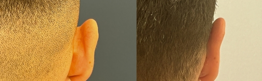 הצמדת אוזניים - 20 - אחורי