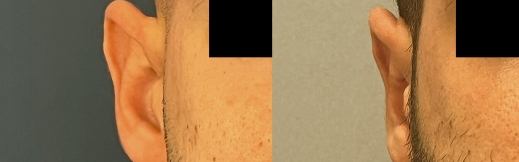 הצמדת אוזניים - 20 - ימין