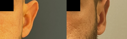 הצמדת אוזניים - 20 - שמאל