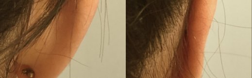 הצמדת אוזניים תמונה לפני ואחרי 10
