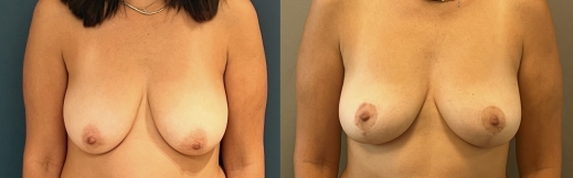 הרמת חזה - 14- פרונט