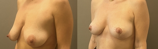 הרמת חזה - 18- ימין