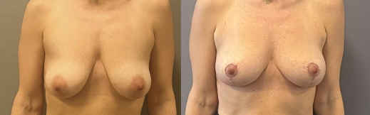 הרמת חזה - 18- פרונט