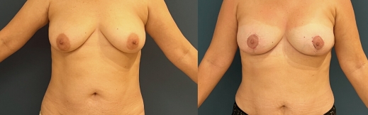 הרמת חזה עם שתל - 33 - חזה בטן