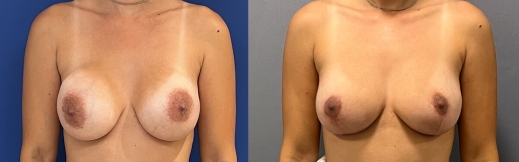 הרמת חזה עם שתל - 34 - פרונט