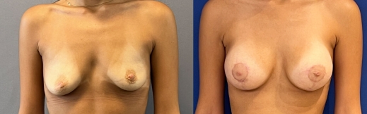 הרמת חזה עם שתל - 35 - פרונט